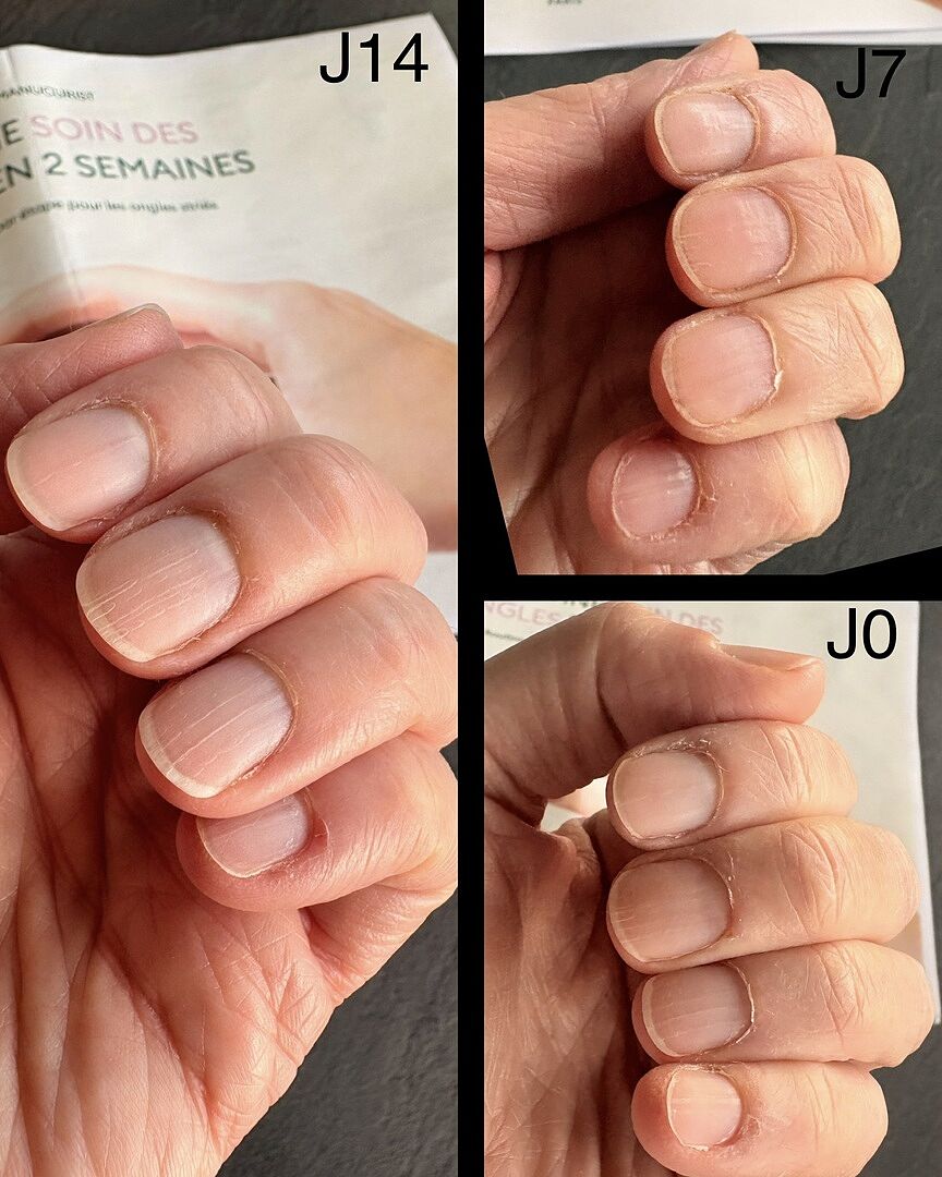 Ongles nourris