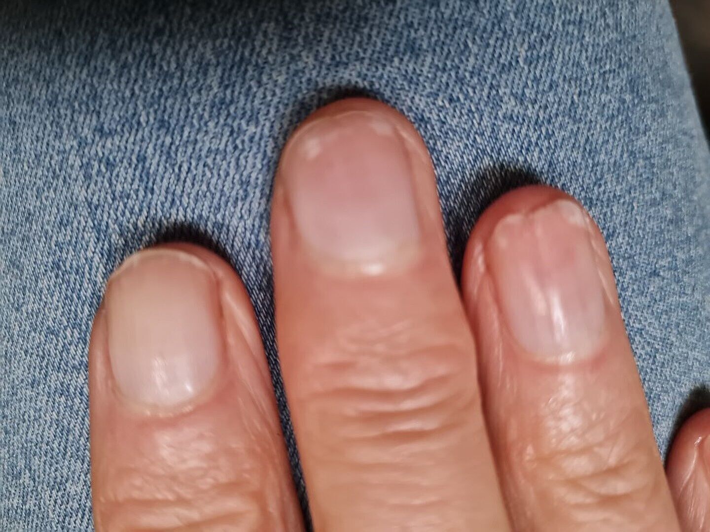 Après gel